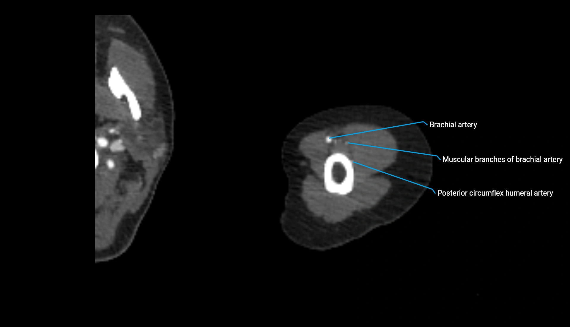 CTA upper limb axial cross sectional anatomy labelled image 281 (2).webp